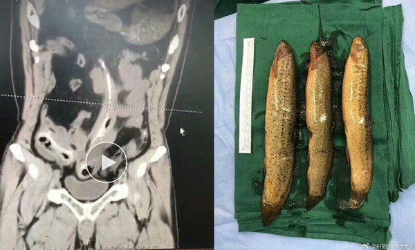 他肛門塞3條大泥鰍「順著直腸鑽進肚子」　醫剖腹取出：據說是台灣品種。（圖／翻攝「肝膽外科羅大夫」微博）