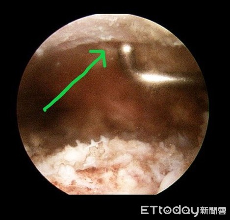 ▲台南市立安南醫院骨科許惟傑醫師指出，肩峰骨刺合併旋轉肌腱破裂，經施行微創關節鏡手術後恢復良好。（圖／記者林悅翻攝，下同）