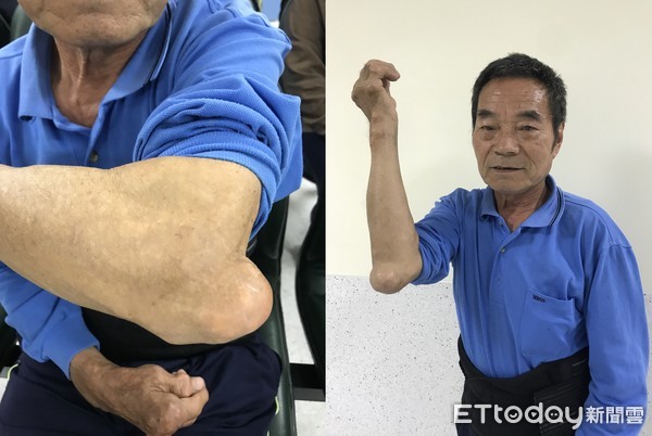 ▲▼退休運將狂吃海鮮、火鍋 關節變形罹痛風如針刺。（圖／烏日林新醫院提供）