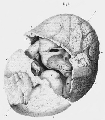 「胎兒石化」（lithopedion）（圖：胎兒石化示意圖／WiKi）