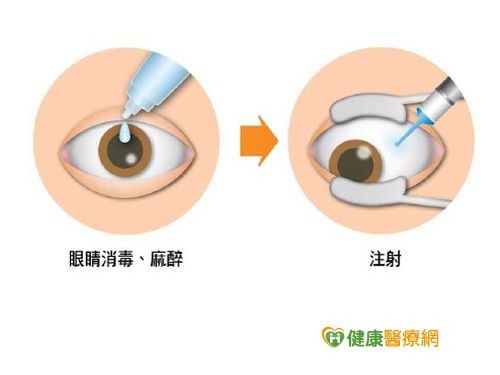 老人黃斑部病變不治療恐失明 Ettoday健康雲 Ettoday新聞雲