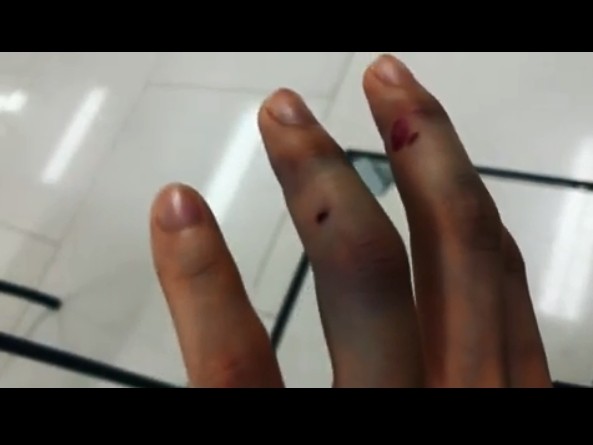 ▲林芊妤手指遭電梯鐵門夾傷。（圖／翻攝自林芊妤Instagram）