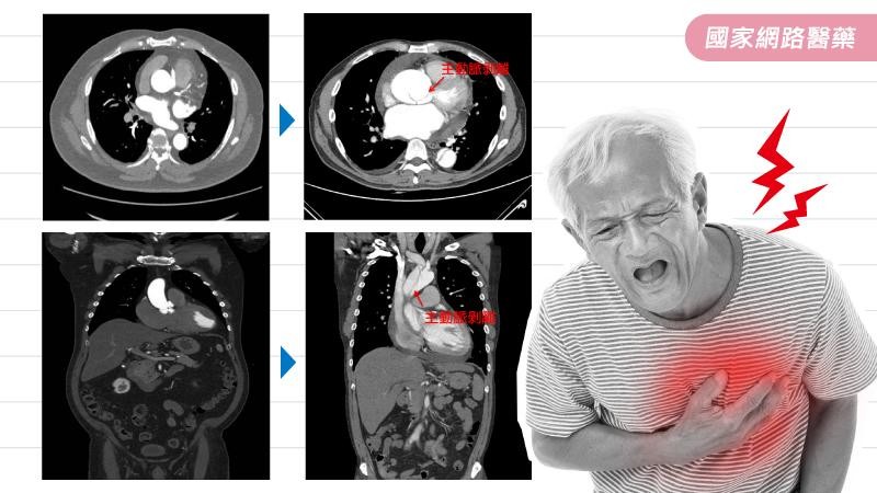 ▲▼心肌梗塞,主動脈剝離。（圖／kingnet國家網路醫藥提供）