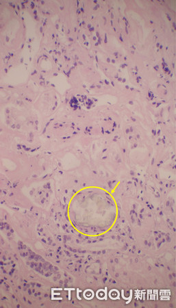 ▲▼圖一：腎小管萎縮，腎臟間質纖維化。圖二：從偏光顯微鏡下，可以看出腎小管有草酸鹽結晶體。。（圖／澄清醫院中港院區提供）