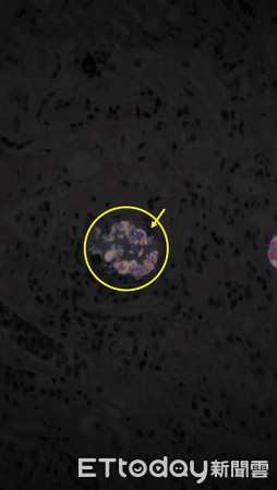 ▲▼圖一：腎小管萎縮，腎臟間質纖維化。圖二：從偏光顯微鏡下，可以看出腎小管有草酸鹽結晶體。。（圖／澄清醫院中港院區提供）