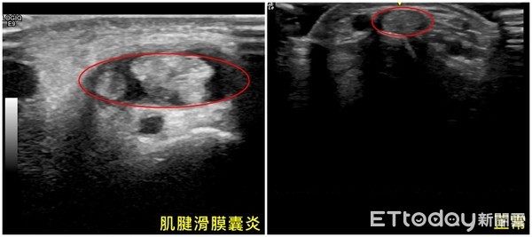 ▲▼亞大醫院復健科主治醫師簡郁佩替患者掃超音波檢查是否罹患媽媽手。（圖非當事人）