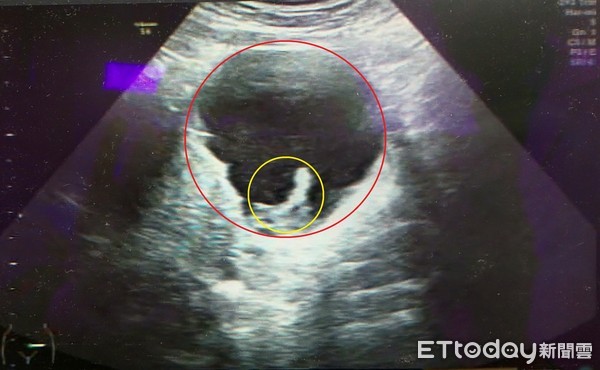 ▲陳小姐左邊卵巢有8公分的囊腫(紅圈處)且合併有硬塊(紅圈處)，若不妥善處理會有破裂的風險。（圖／記者黃孟珍翻攝）
