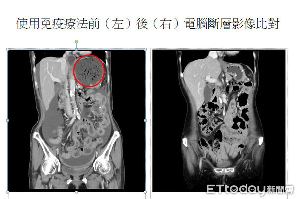 胃癌末期案例。（圖／台中慈濟醫院提供）