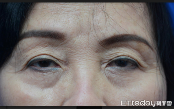 ▲開眼瞼患者大開眼界 走路不再撞牆。（圖／高醫提供）