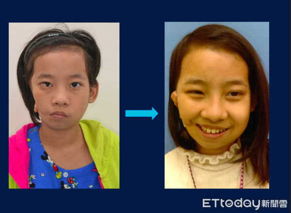 ▲緬甸女童小勒經台醫協助「長出耳朵、改善視力」，獲得新生。（圖／中國附醫提供）