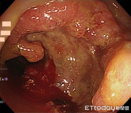 ▲▼直腸癌。（圖／澄清醫院提供）