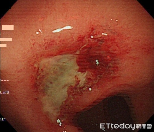 ▲▼直腸癌。（圖／澄清醫院提供）