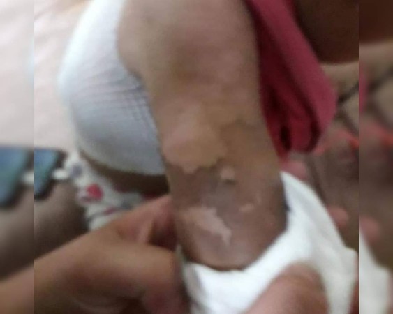 ▲楊男幫2歲女兒洗澡時，將女兒燙傷脫了一層皮。（圖／翻攝自Facebook／爆料公社，以下同）