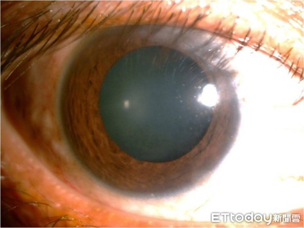 ▲眼睛蝴蝶餅。（圖／陳偉勵醫師提供）