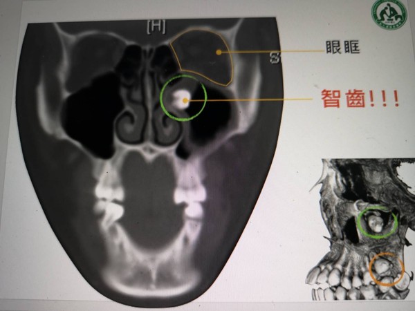 ▲18歲正妹智齒長在左眼下方。（圖／彰化基督教醫院提供）