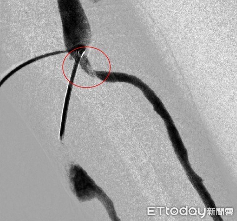 ▲▼亞大醫院心臟血管外科主任劉殷佐（後者）為林阿姨通血管。（圖／亞大醫院提供）