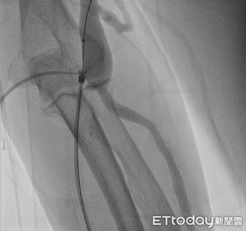 ▲▼亞大醫院心臟血管外科主任劉殷佐（後者）為林阿姨通血管。（圖／亞大醫院提供）
