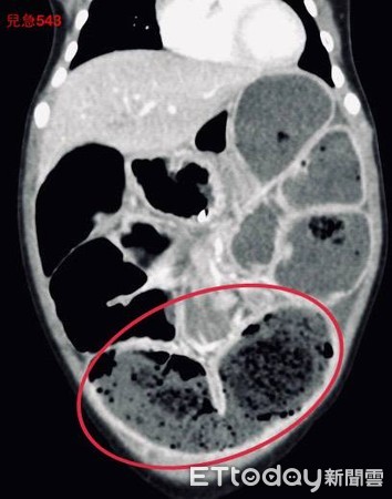 ▲宿便。（圖／吳昌騰醫師提供）