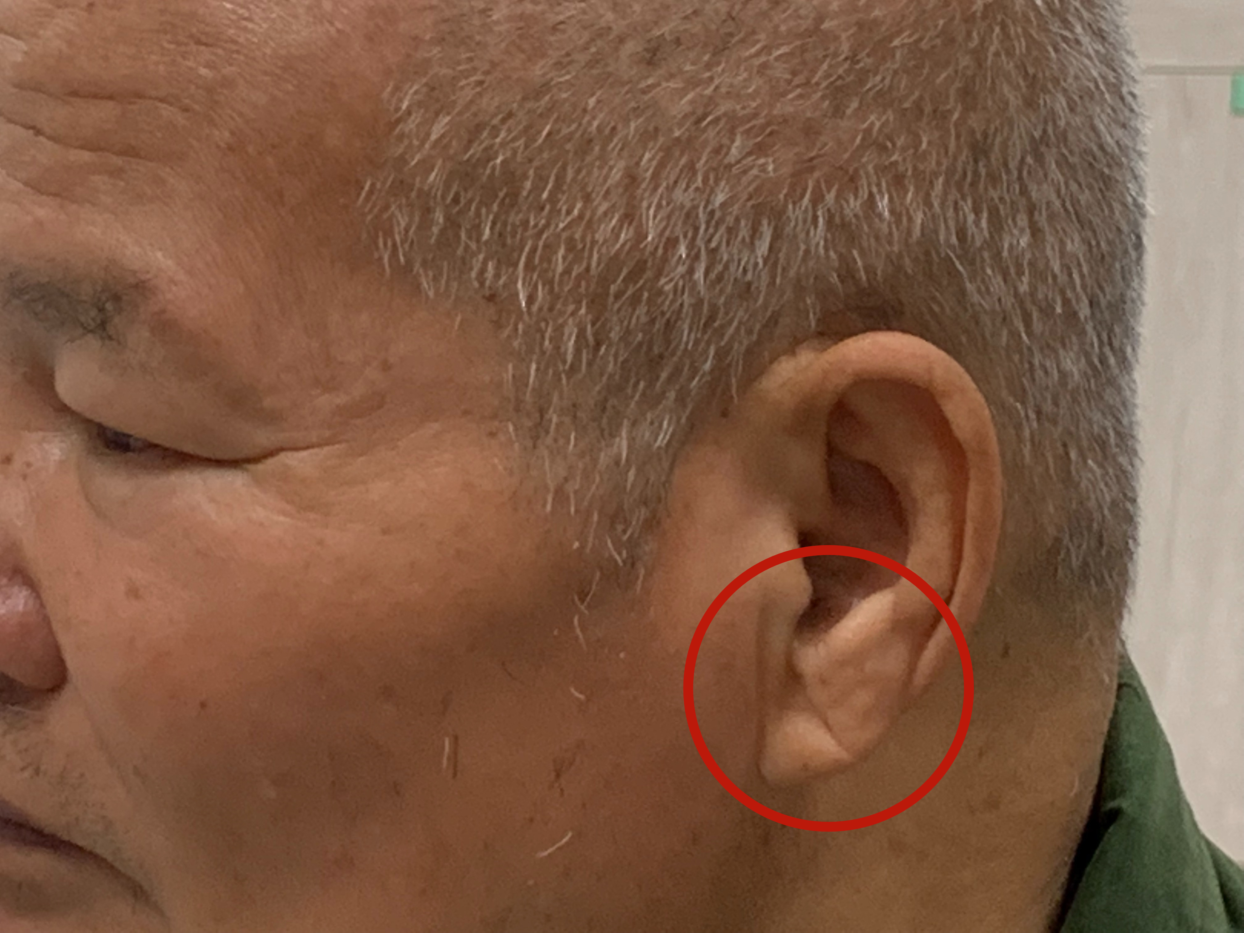 網傳「耳垂有皺摺」是心臟病前兆？ 醫：這次是真的！ | ETtoday健康雲| ETtoday新聞雲