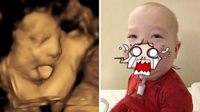 超音波拍到「寶寶吐舌」以為在賣萌！產婦生完看見全臉，驚覺大事不妙