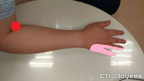 ▲肘隧道症候群早期的症狀是無名指與小指的麻痺、刺痛及肘關節內側的酸痛。（圖／記者林悅翻攝，下同）