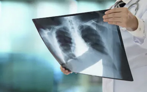▲▼ 胸腔X光。（圖／取自圖庫Shutterstock）