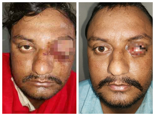 ▲印度男子眼球被牛角攻擊挖出。（圖／翻攝自BMJ Case report）