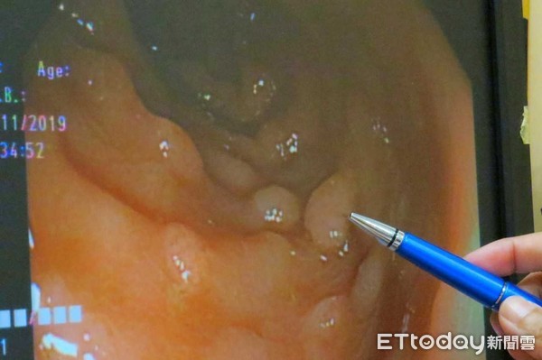 ▲▼腸息肉。（圖／台中慈濟醫院提供）