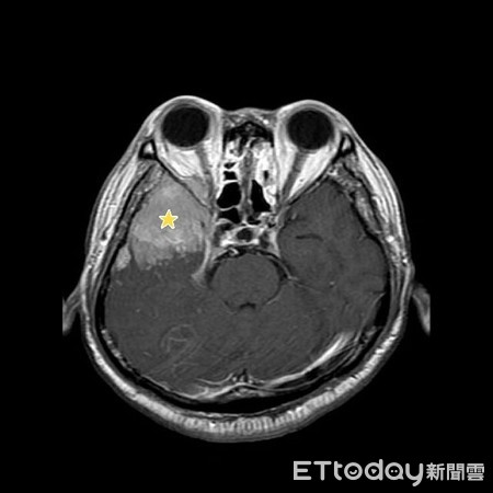 ▲台南安南醫院眼科主任徐聖曜醫師，檢查發現患者右眼視野完全缺損，視力也只能看到眼前15公分物體，腦部掃描診斷出五公分腦膜瘤，壓迫到視神經。（圖／記者林悅翻攝，下同）