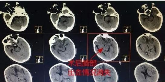 ▲▼王男手術後已經恢復意識。（圖／翻攝自微博）