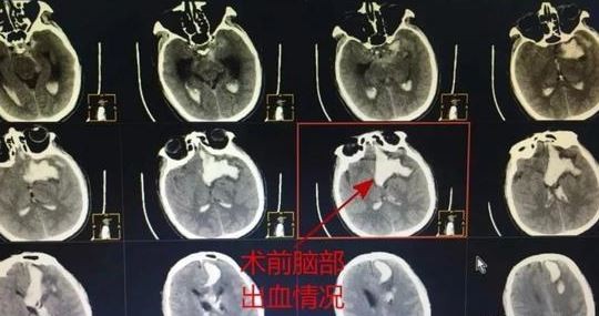 ▲▼王男手術後已經恢復意識。（圖／翻攝自微博）