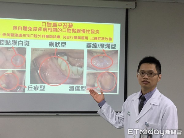 ▲邱聖富醫師提醒，當民眾發生上述口腔症狀時，請先到有口腔顎面外科或口腔病理科的醫院就診，讓醫師做診斷並治療，切勿自行到藥局買藥塗抹或服用以免延誤病情。（圖／記者林悅攝）