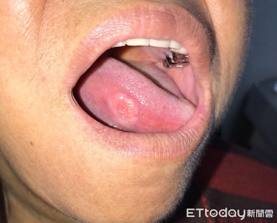她舌破「粉黃爛洞」醫：口腔癌第二期。（圖／南投醫院提供）