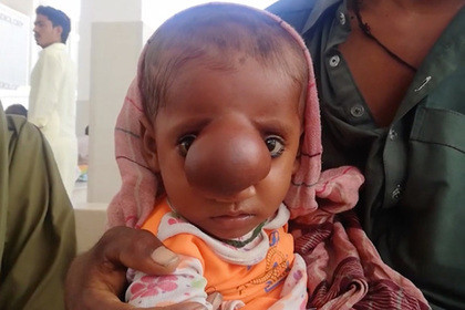 ▲巴基斯坦的小丑鼻寶寶。（圖／翻攝自LENTA.RU）