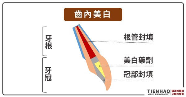 牙齒美白。（圖／張添皓醫師提供）