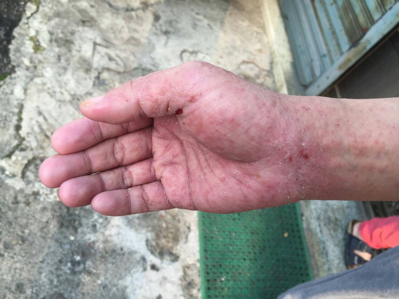 1人得全家小心 醫授 預防疥瘡 4大要點衣物 毛巾都會傳染 Ettoday健康雲 Ettoday新聞雲