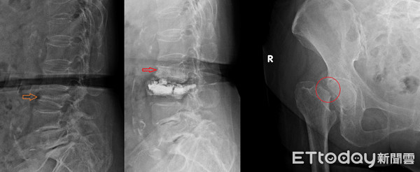 沒跌倒骨頭斷3處！她骨鬆變「陶瓷娃娃」。（圖／活力得中山脊椎外科醫院提供）