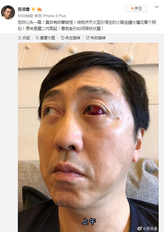 ▲庾澄慶不知道什麼原因左眼佈滿血塊，就像動漫火影忍者裡的「血輪眼」。（圖／翻攝自微博／庾澄慶）