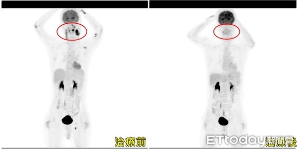 ▲▼亞大醫院癌症中心副院長暨血液腫瘤科主任黃文豊替患者檢查頸部腫塊。（圖非當事人）。（圖／亞大醫院提供）