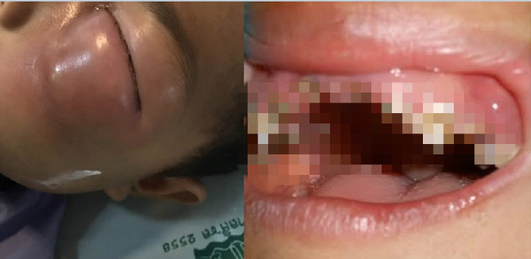 3歲童太愛吃糖滿口蛀牙　「牙菌擴散左眼」害他差點失明。（圖／翻攝自Facebook／Arak Wongworachat）