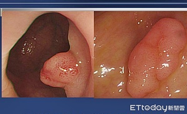 ▲▼大腸癌、腸鏡、大腸息肉。（示意圖／記者林悅翻攝）