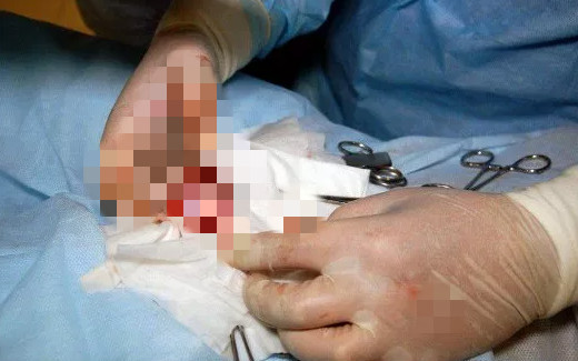 ▲莫斯科男童一顆臼齒在睪丸裡長大。（圖／翻攝自VK）