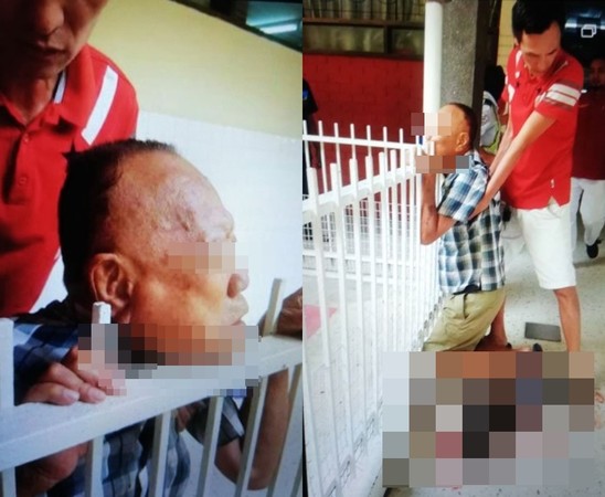 ▲▼馬來西亞78歲翁被鐵柵欄刺穿下顎。（圖／翻攝自微博游游大太平群組） 