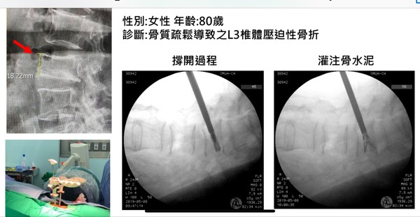 ▲台灣自主研發生產「椎體撐開器」　中醫大搶先應用骨折患者。（圖／中醫大新竹附醫提供）