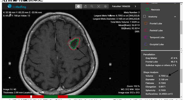 ▲北榮AI自動判讀轉移性腦瘤系統，在幾秒內就能在MRI影像上自動偵測轉移性腦腫瘤的位置。（圖／台北榮總提供）