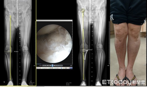 ▲52歲張先生經安南醫院骨科許峻誠醫師，施以高位脛骨截骨手術保留原有膝關節及改善膝蓋變形，術後2個月即可正常行走。（圖／記者林悅翻攝，下同）