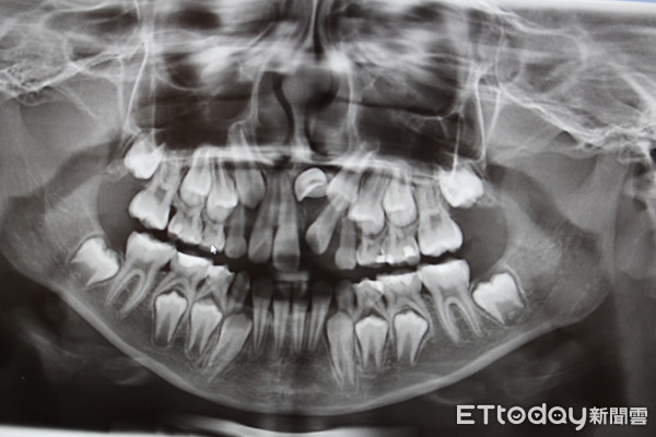 ▲▼女童恆牙橫長。（圖／記者陳玉翻攝）