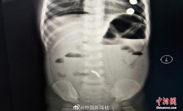 2歲女連吞14顆磁石　醫檢查驚現腸管壞死「5處穿孔」。（圖／翻攝自大陸《中新網》）