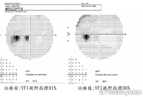 ▲患者經過半年中醫降虛火、針灸刺激眼部穴道等治療，不用再使用類固醇藥水，眼壓也降到正常值，視野提高到96％。（圖／記者林悅翻攝，下同）