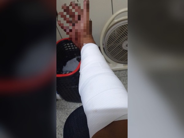 ▲張男右手臂遭人砍傷。（圖／翻攝自當事人臉書）